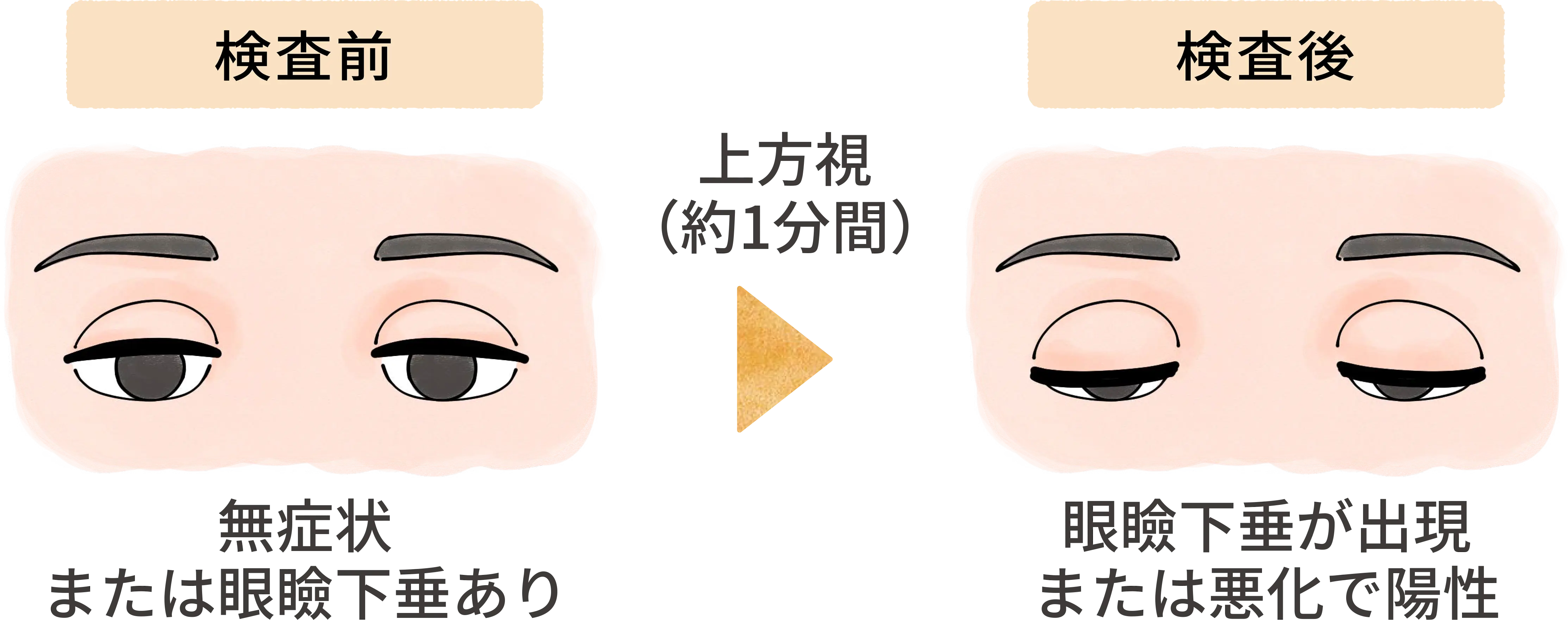 眼瞼の易疲労性試験