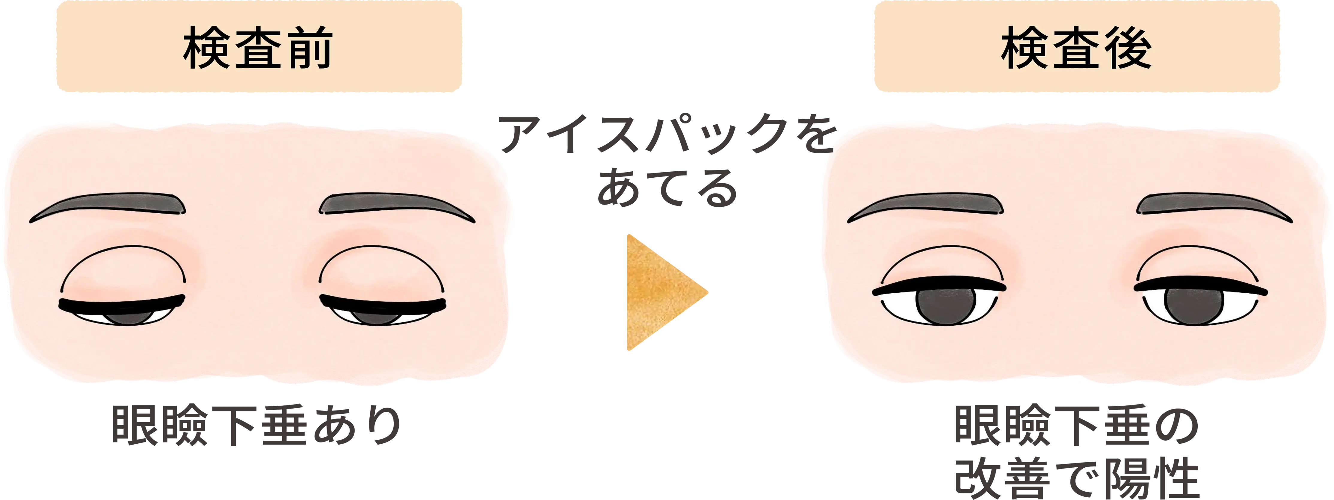 アイスパック試験