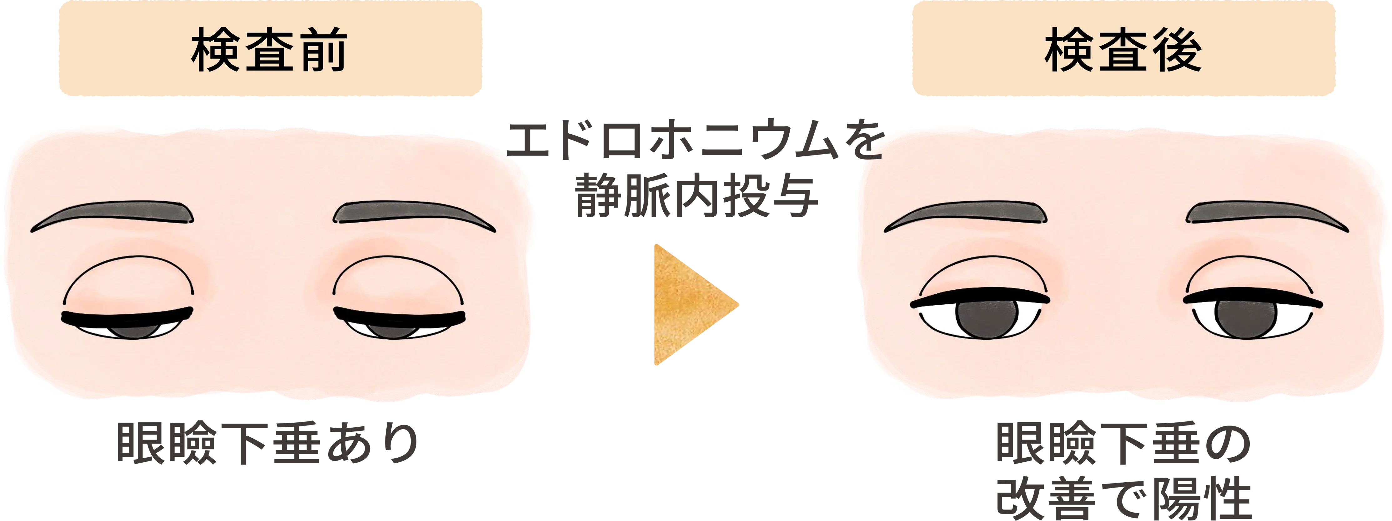 エドロホニウム（テンシロン）試験