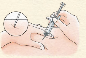 つまんだ皮膚に対して、45°から90°の角度で針を刺します