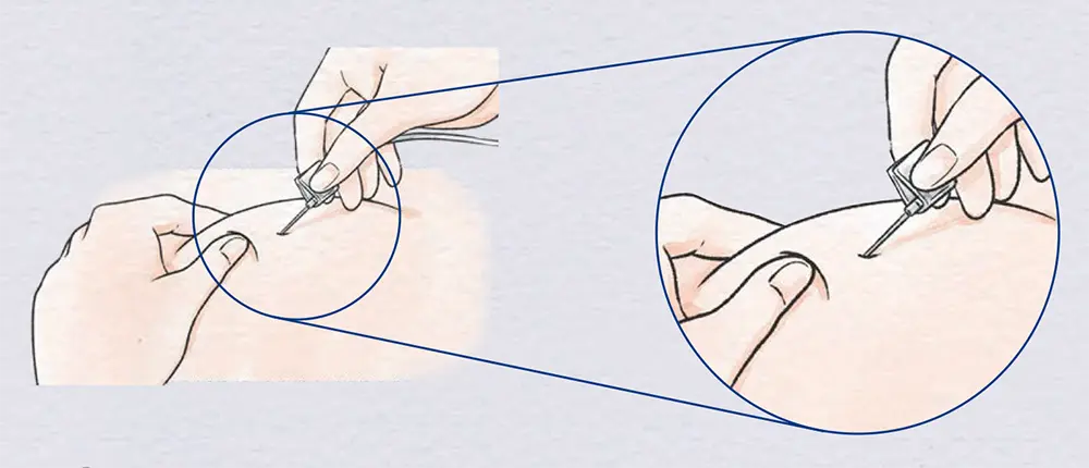 翼状針を持っていない方の手で、消毒した部位をしっかりつまみ、つまんだ皮膚に対して約60°の角度で針を刺します
